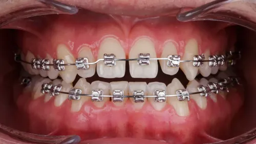 Braces Metal Treatment service image