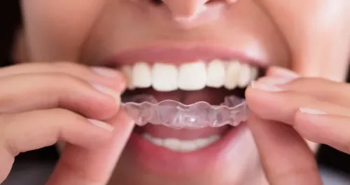 Retainers Treatment service image