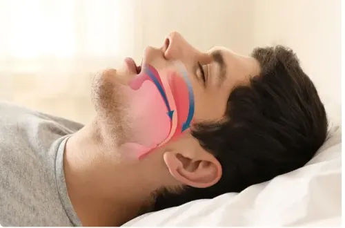 Sleep Apnoea and Snoring Treatment service image