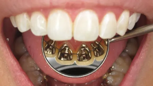 Lingual Braces Treatment service image