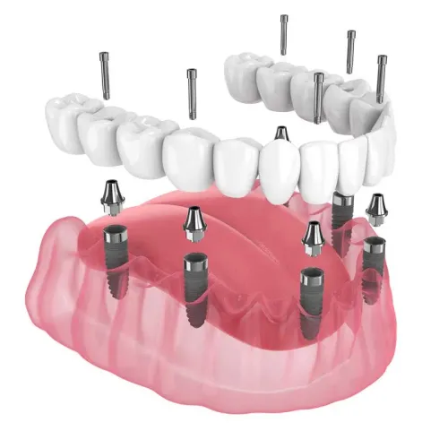 Full Arch Implants  service image