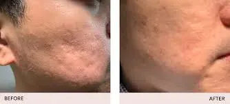 Acne , Scar and Pigmentation Management service image