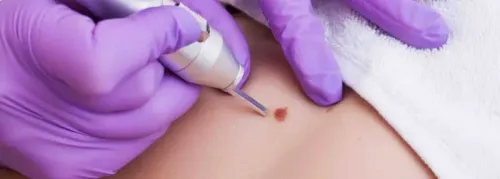 Removal of Warts, Moles, Molluscum Contagiosum service image