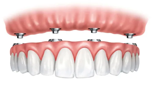 Full Arch Implants service image
