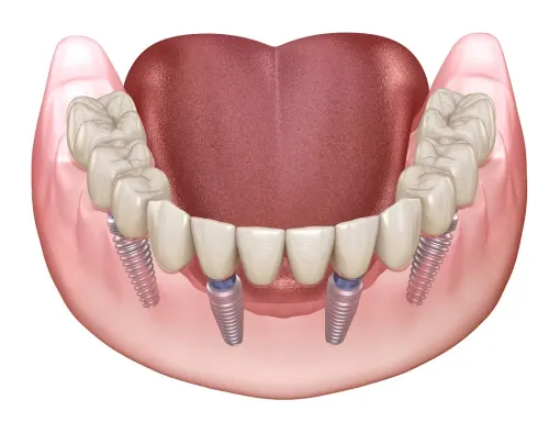 Full Mouth Rehabilitation service image