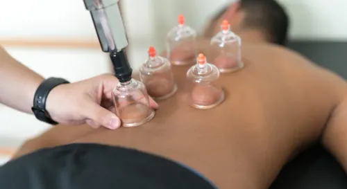  Cupping Therapy  service image