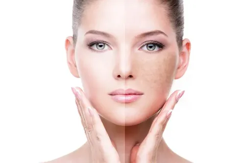 Skin Pigmentation Treatment in Aundh, Sanghvi, Baner, Balewadi, Pashan, Pune service image