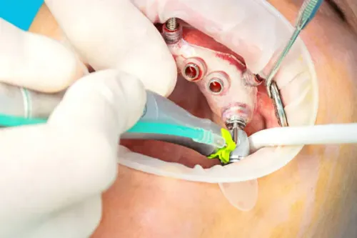 Dental Implant Surgeries service image
