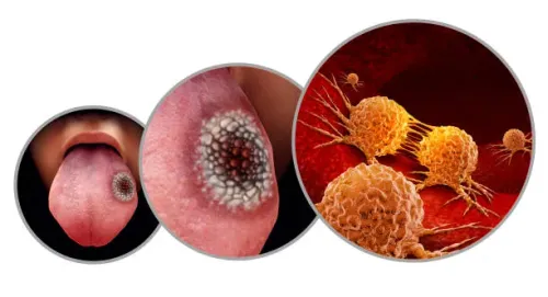 Oral Cancer Treatment service image