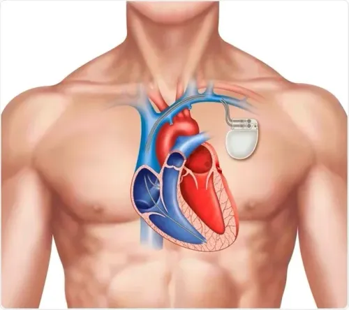 Permanent Pacemaker service image