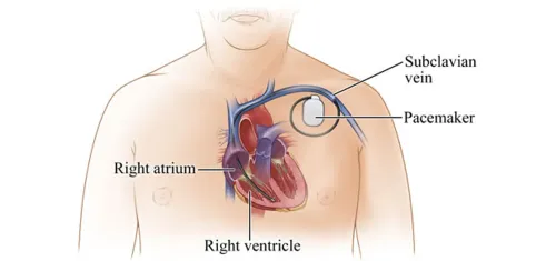 Temporary Pacemaker service image