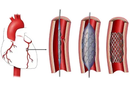 Coronary Angioplasty service image