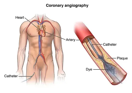 Coronary Angiography service image