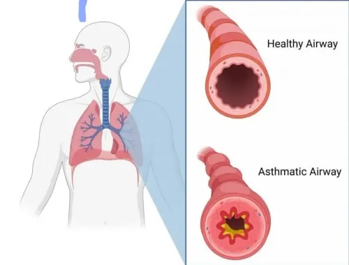 ASTHMA  service image