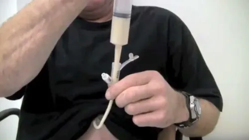 PED Feeding Tube Treatment service image