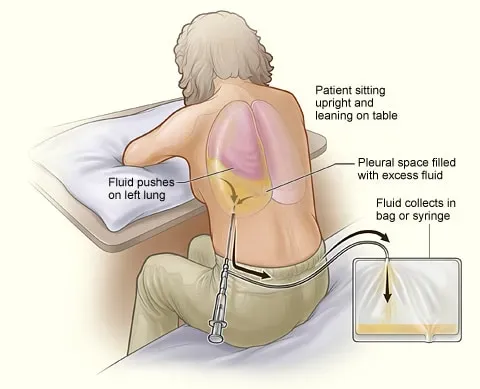 Pleurodesis Surgery service image