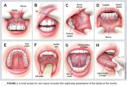 Evaluation of Oral Cancers service image