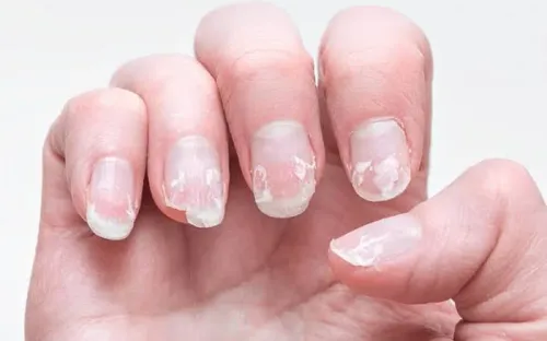 Nail Disorders in Children service image