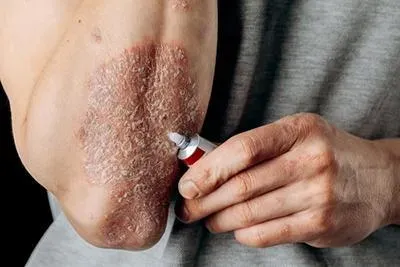 Psoriasis and Chronic Skin Condition service image