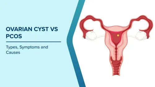 Management of PCOS and Ovarian Cysts service image