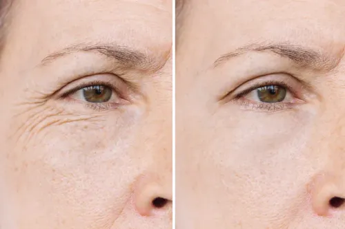 Fine lines and wrinkle reduction service image