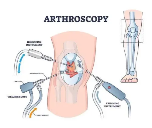 Arthroscopy Procedures  product image