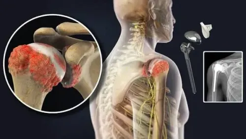 Shoulder Replacement Surgeon  product image