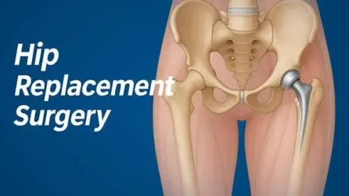 Hip Replacement Surgery product image