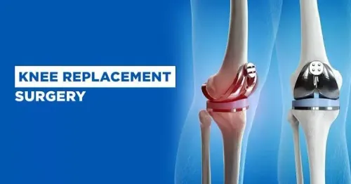 Knee Replacement Surgery product image