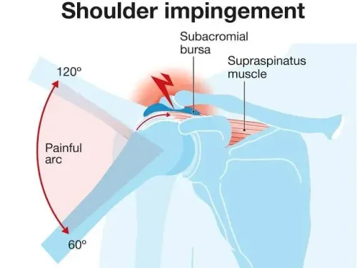 Shoulder Impingement Syndrome service image