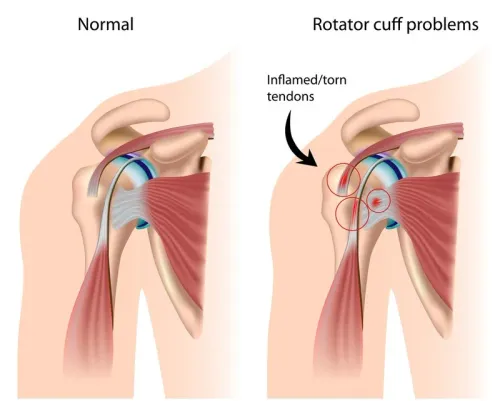 Rotator Cuff Injury/Tear service image