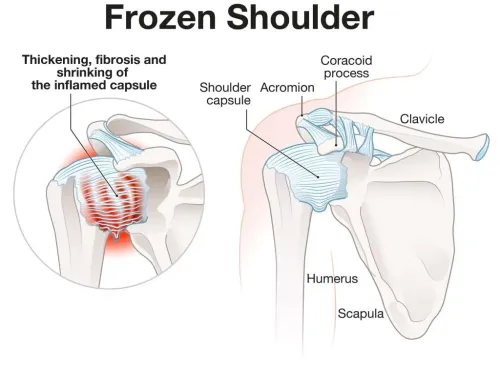 Frozen Shoulder (Adhesive Capsulitis) service image