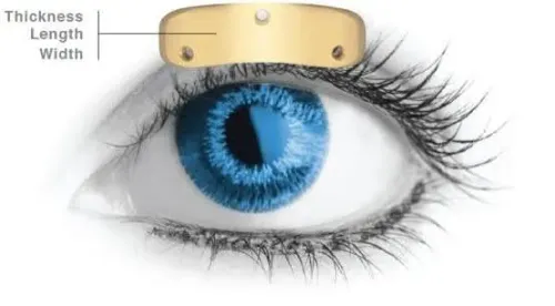 Eye Gold Implant service image