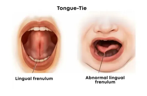 Tongue Tie Release Surgery service image