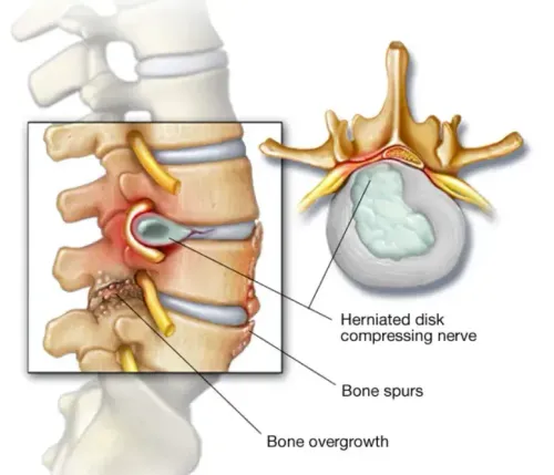 Spinal Stenosis service image