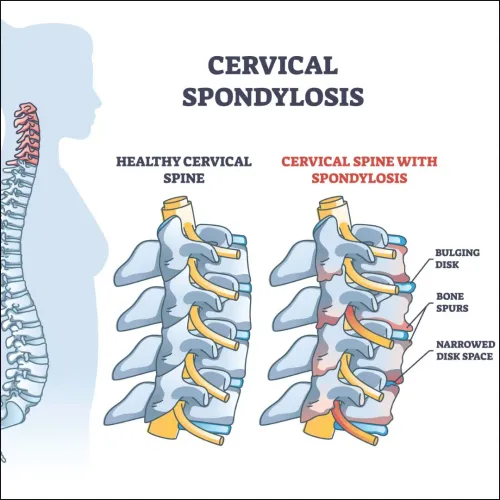 Cervical Spondylosis service image