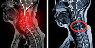 Cervical Myelopathy service image