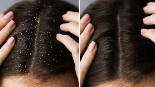 Scalp conditions and dandruff treatment service image