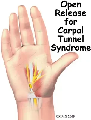 Carpal Tunnel Release service image