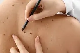Wart, mole, and skin tag removal service image