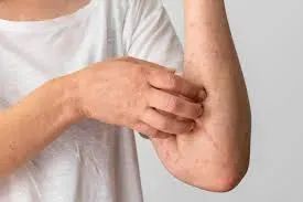 Skin allergy and infection treatment service image