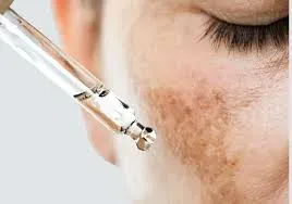 Pigmentation and melasma management service image