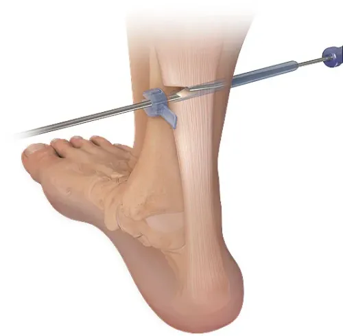 Soft Tissue Repair Treatment service image