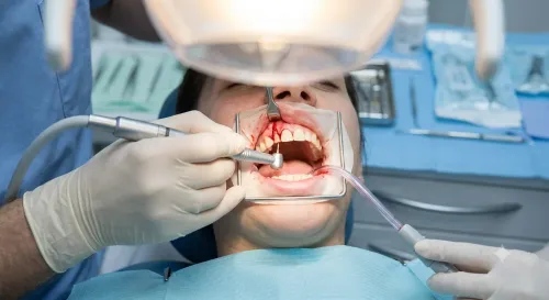 Apicoectomy service image