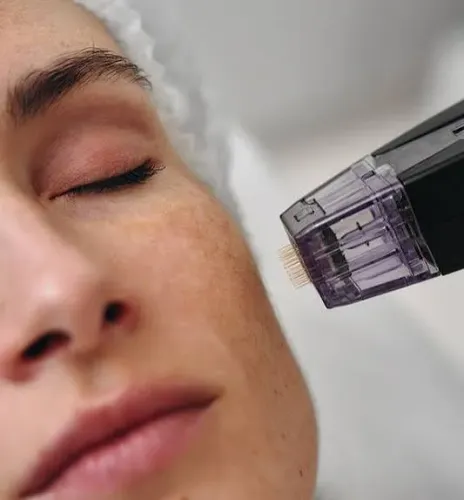 morpheus8 Treatment  service image
