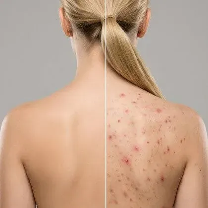 Body Acne service image
