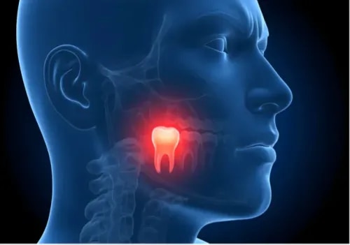 Wisdom Teeth Removal to Relieve Pain and Jaw Discomfort service image
