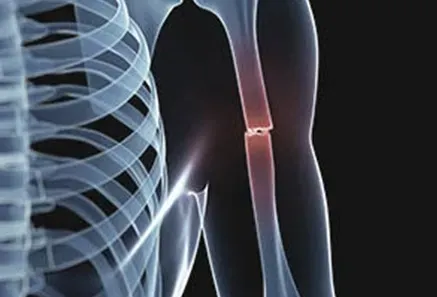 Trauma & Fracture Specialist in Bibwewadi, Dhankawadi, Pune service image