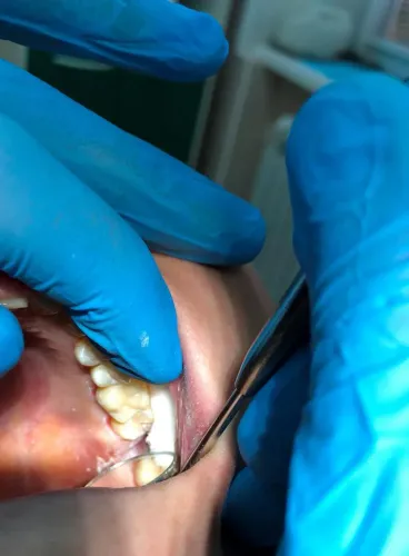 Tooth-Colored Fillings service image