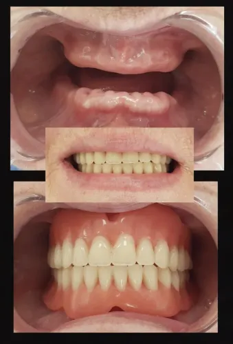 Dentures (Complete & Partial) service image